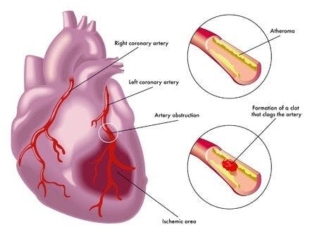 Fatal Arrhythmia Causes Sudden Cardiac Death