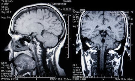 Undiagnosed Brain Aneurysm Ruptures, Results in Death