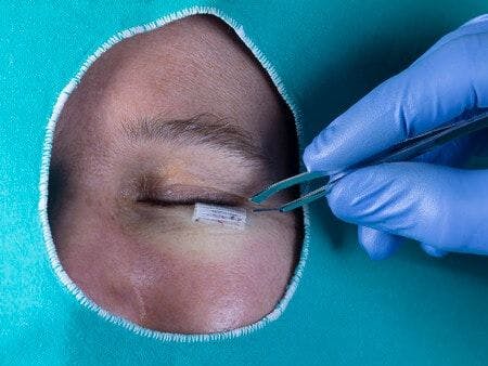 Negligent Administration of Ophthalmic Anesthesia Causes Permanent Loss of Vision