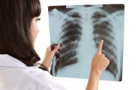 Lung Cancer Missed as Physician Fails to Place Order for Imaging Study