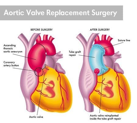 Cardiothoracic Surgery Expert Witness Advises on Failed Aortic Valve Replacement Surgery