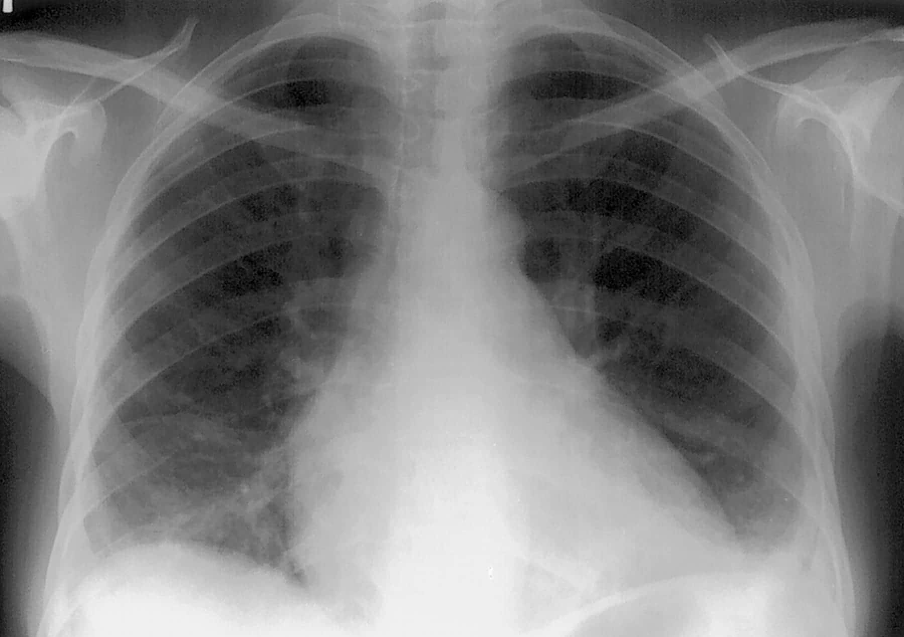 ER Expert Witness Opines on Acute Chest Syndrome Diagnosis