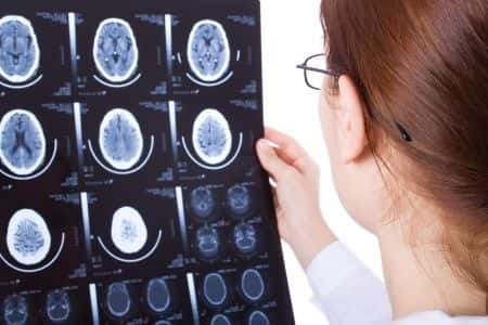 Neurology expert witness advises on man’s allegegations that a fall caused brain injury