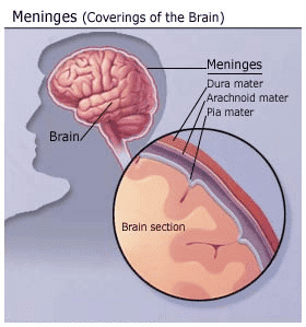 Missed Diagnosis of Meningitis Leads to Patient’s Death