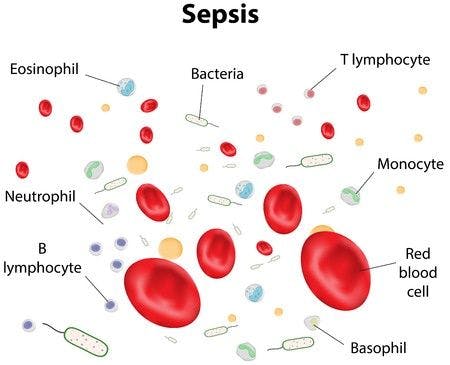 HIV Patient Dies From Sepsis