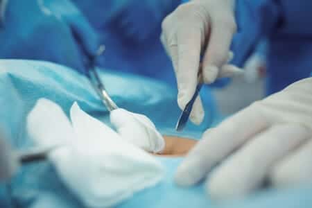 Transplant Surgeon Nicks Patient’s Ureter Causing Kidney Failure