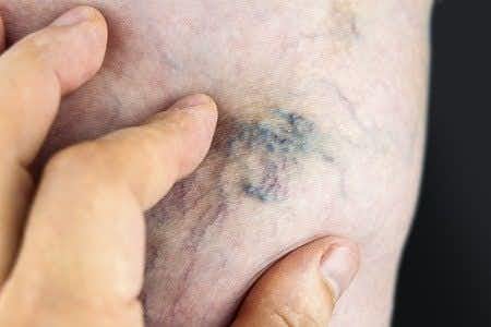 Varicose Vein Excision Procedure Causes Severe Skin Necrosis