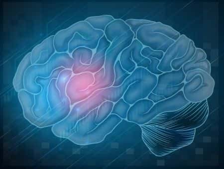 Doctors Fail to Diagnose Ischemic Stroke
