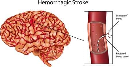 Neurologist’s Workup of Stroke Patient Contributes to Cerebral Death