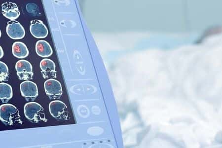 Delayed Diagnosis of Cerebral Hemorrhage Leads to Neurological Defects