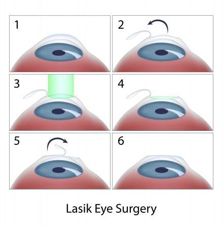 Ophthalmology Expert Witness Opines on Improper LASIK Surgery