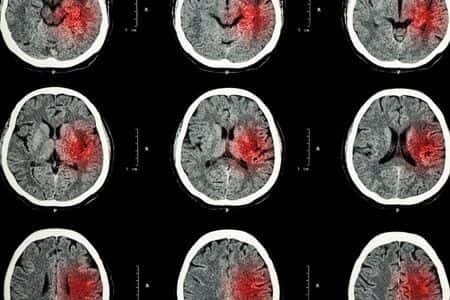 ER Doctors Fail to Diagnose Stroke