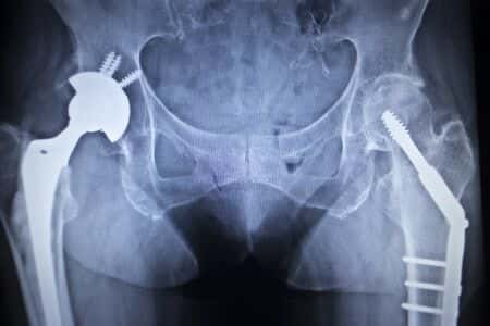 Allegedly Defective Hip Implant Causes Metallosis in Patient