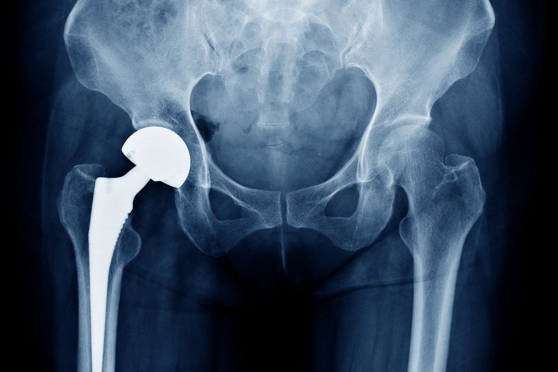 Pinnacle Hip Implant