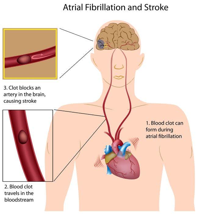 Stroke Risk Management Below Standard of Care in Patient With Atrial Fibrillation