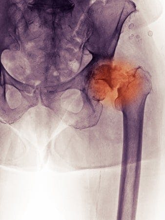 Stryker Orthopedics Hip Replacement Device Poisons Patient