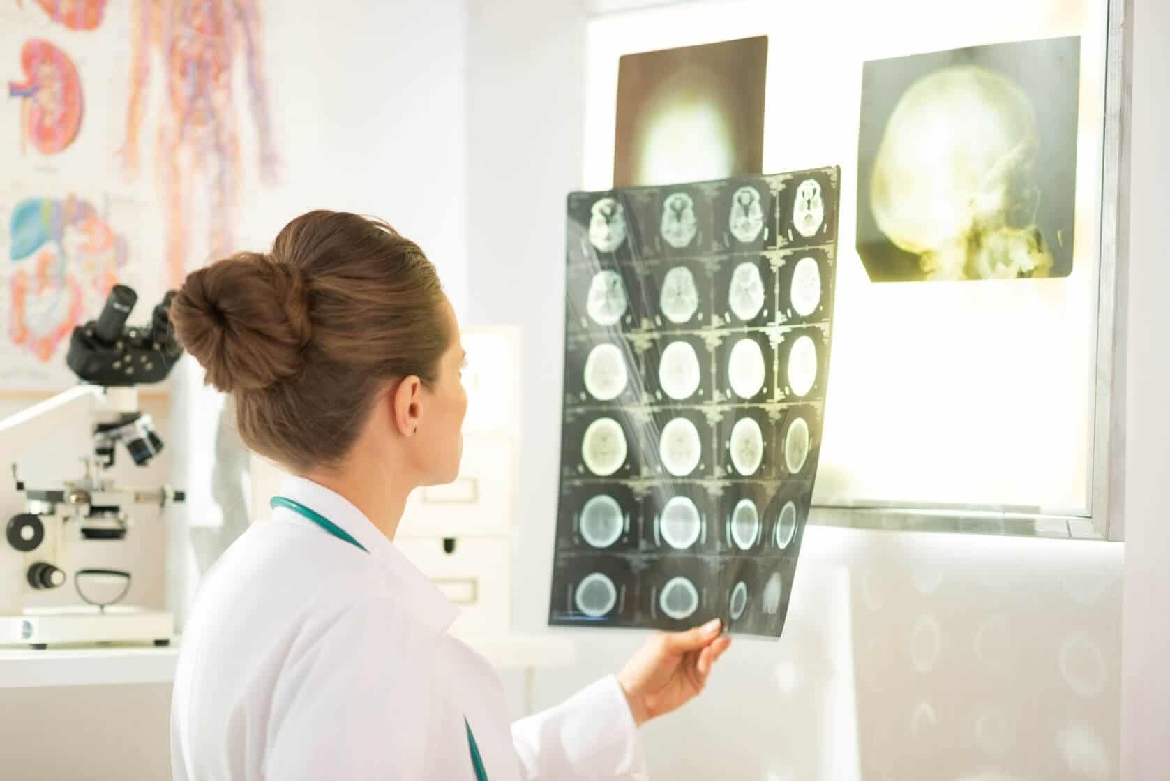Stroke Expert Witness
