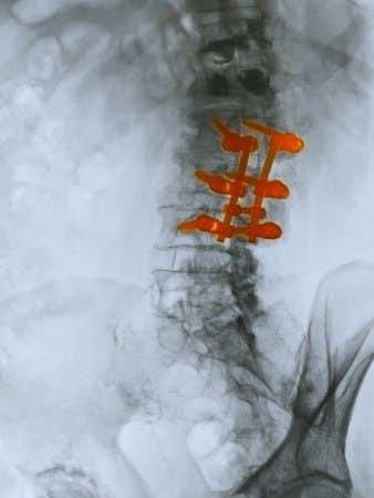 Surgeon Leaves Screw Behind During Spinal Fusion Discectomy