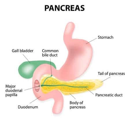 Laparoscopic cholecystectomy error causes pancreatic duct leak