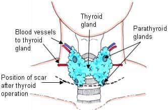 Otolaryngology Expert Witness Comments on Thyroidectomy Complications