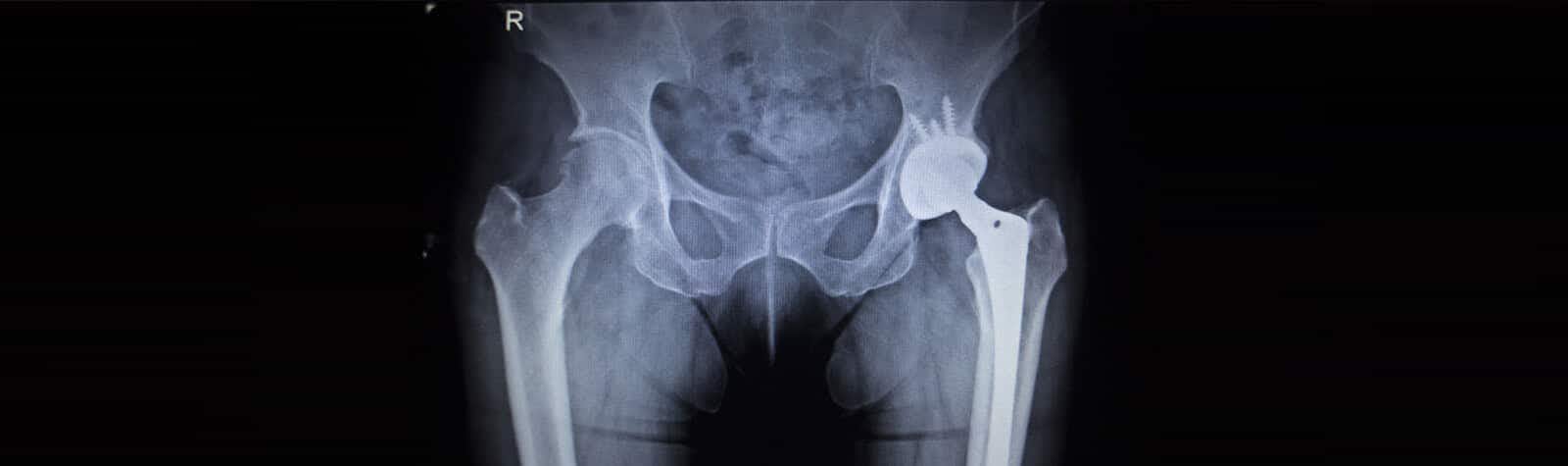 Pinnacle Hip Implant