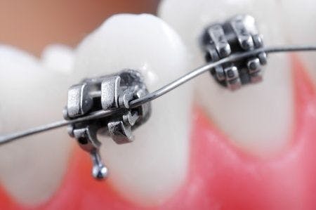 Orthodontics Expert Witness Advises on TMJ Post Procedure