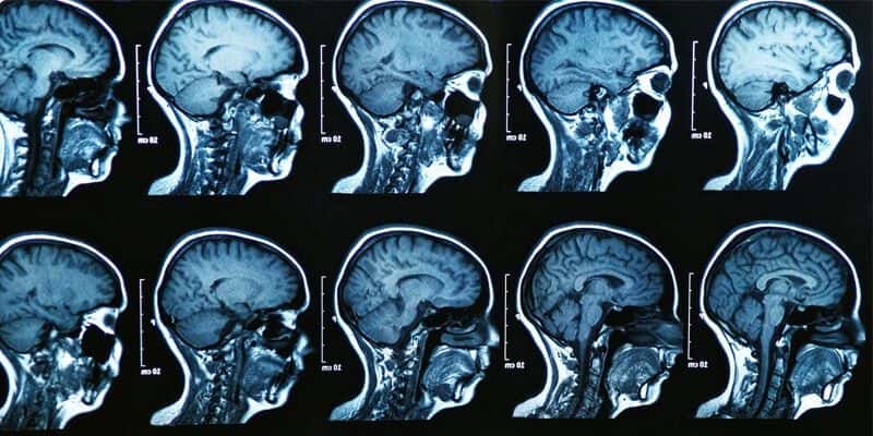 Delayed MRI Allegedly Leads To Patient’s Rapid Neurological Decline