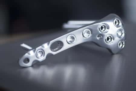 Biomedical Engineering Experts Discuss Failure of Carbon Fiber Fixation Device