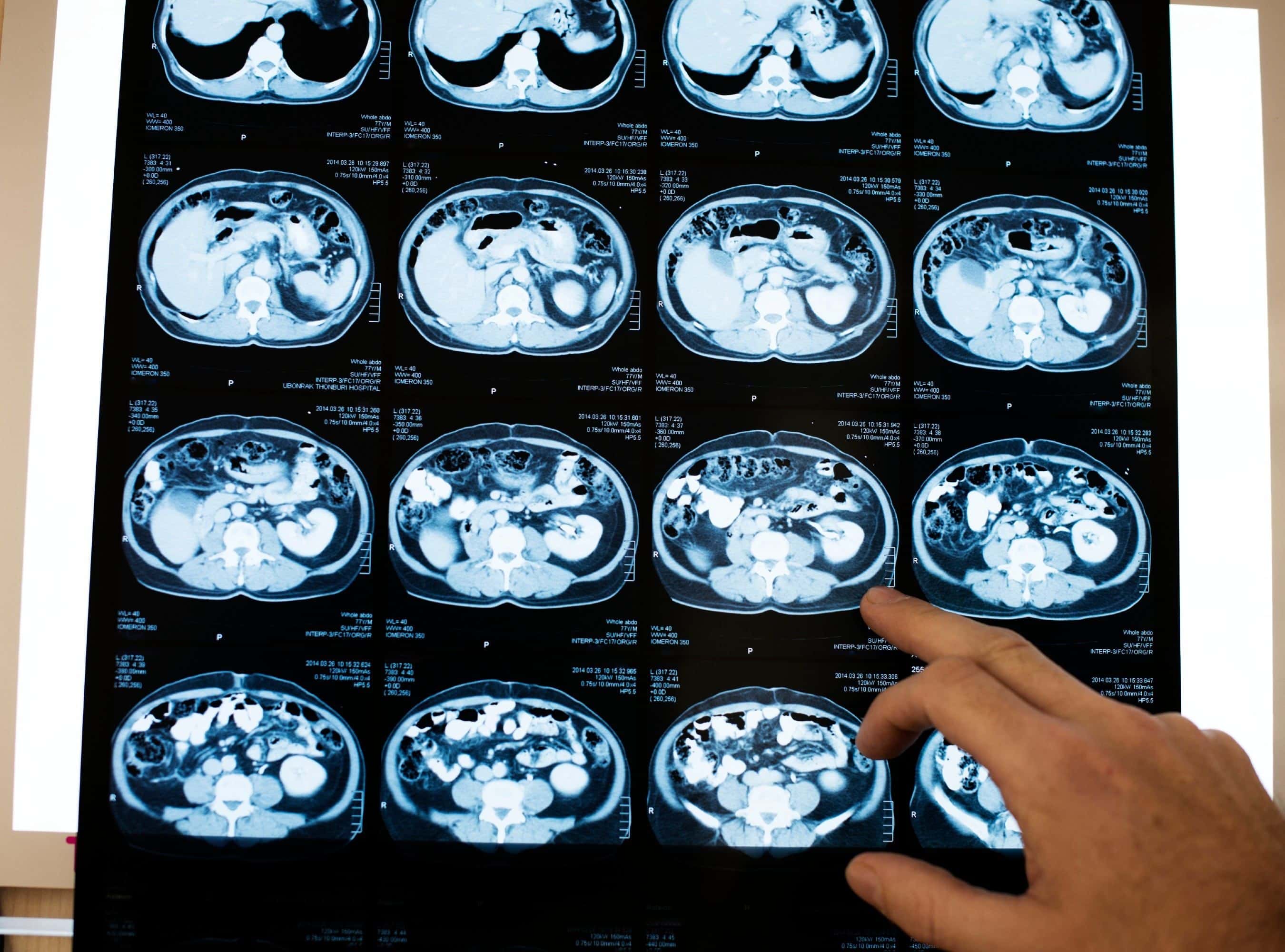 Neuropsychologist Expert’s Testimony Challenged as Speculative and for Lacking Certainty