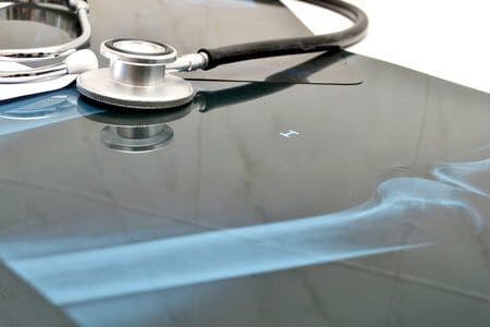 Hip Replacement Manufacturer Sued for Cobalt Poisoning