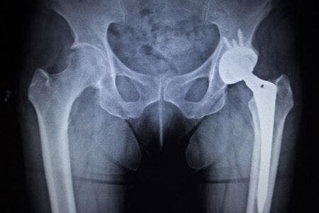 FDA Regulation Expert Opines on Zimmer Hip Replacement Metallosis