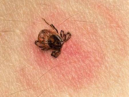 Physician Fails to Diagnose Babesiosis in Patient with History of Lyme Disease