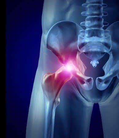 Delayed Diagnosis of Hip Fracture Causes Avascular Necrosis