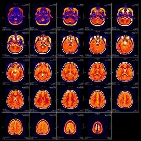 Misdiagnosis of Brain Hemorrhage Leads to Extensive Hospitalization