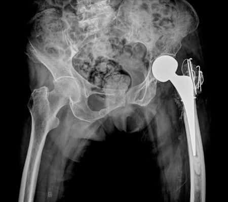 Orthopedic Surgeon Orders Fall Precautions After Patient’s Accident