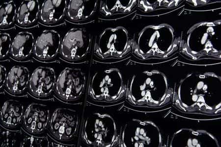 Delayed Diagnosis of Strangulated Bowel Leads to Bowel Resection