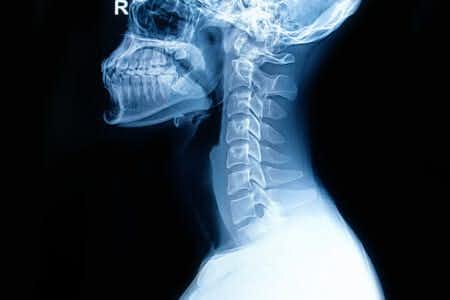 Neurosurgery Experts Discuss Cervical Spine Injury Caused by Vehicle Rollover Accident