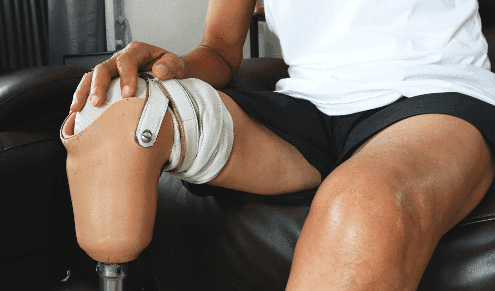 Uterine Artery Embolization Results in Transmetatarsal Amputation