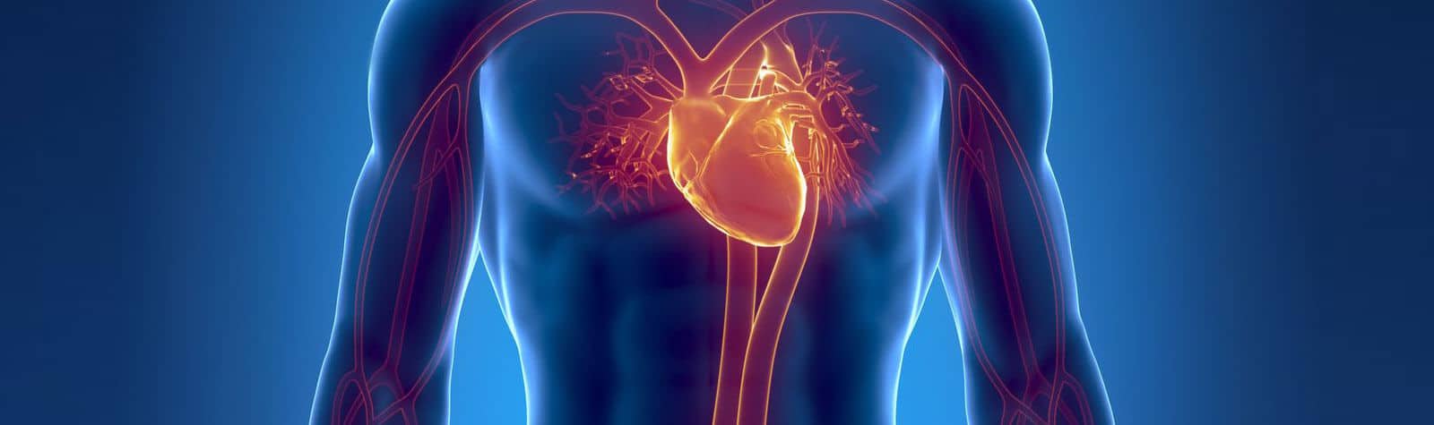IVC Filters - A Litigation Guide