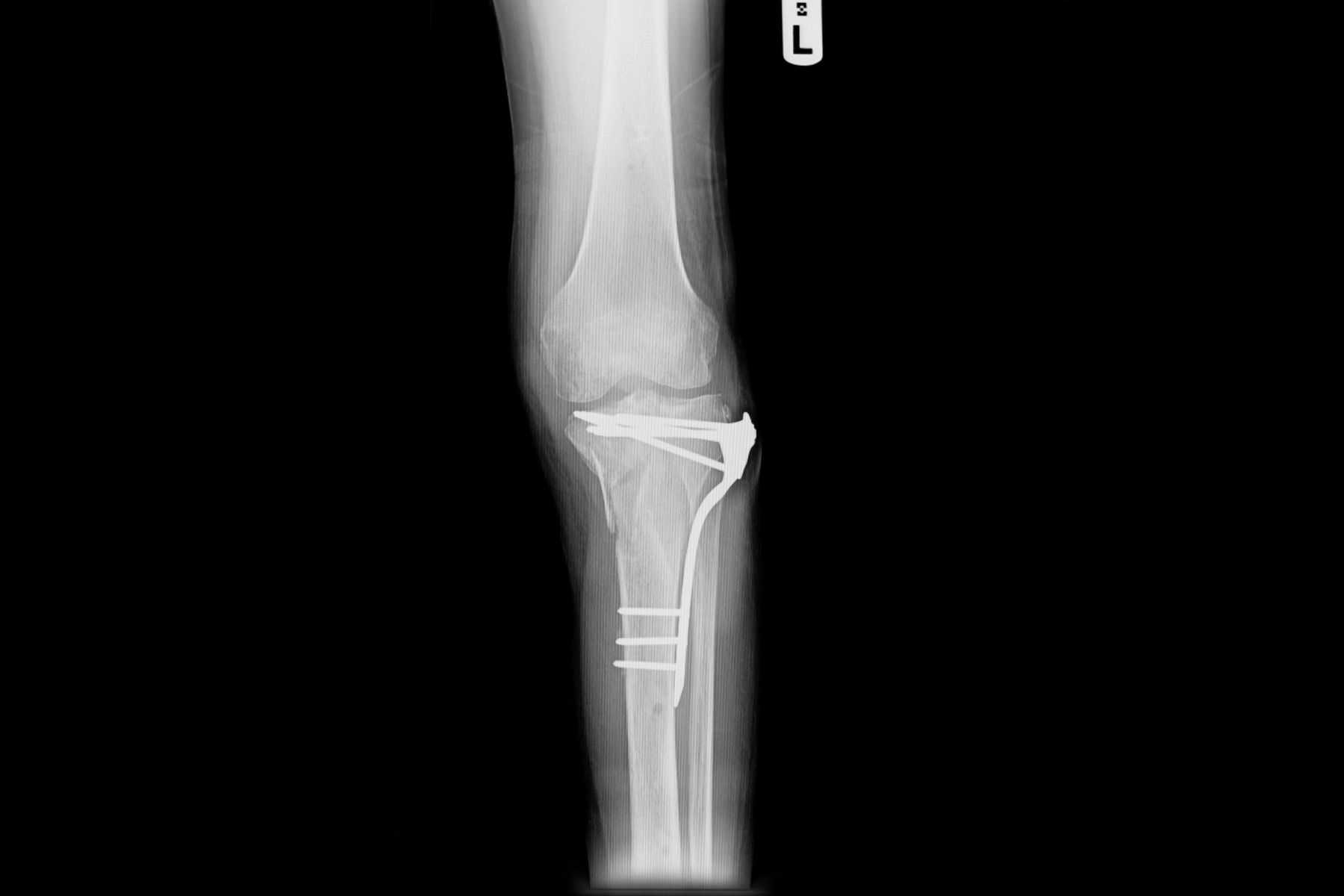 internal of left leg fixed with plate and screws.