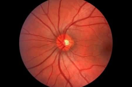 Elective Vitrectomy Procedure Results in Detached Retina