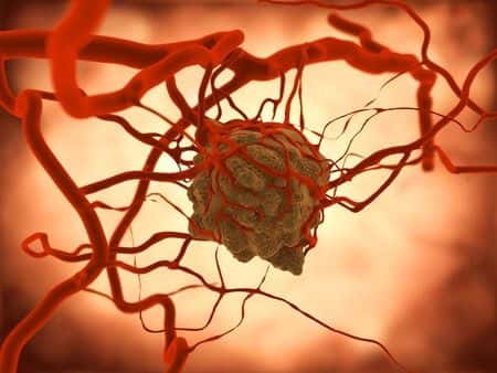 Doctors Misdiagnose Serious Cancer as Low-Grade Adenocarcinoma