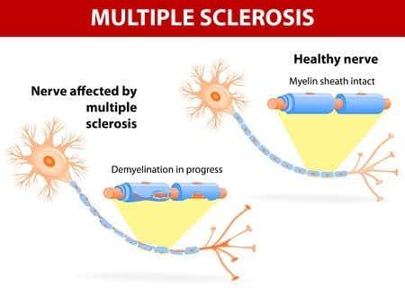 Failure to Treat Advanced Multiple Sclerosis