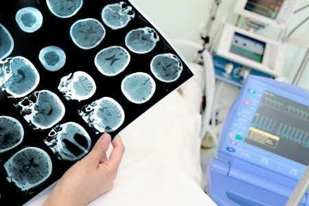 Surgical Negligence Causes Permanent Brain Damage
