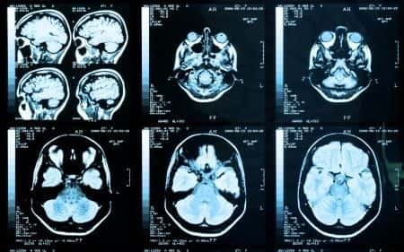 Patient on Coumadin Therapy Sustains a Massive Subdural Hematoma With Brain Herniation