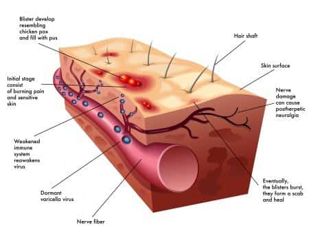 Stevens-Johnson Syndrome Kills Young Boy