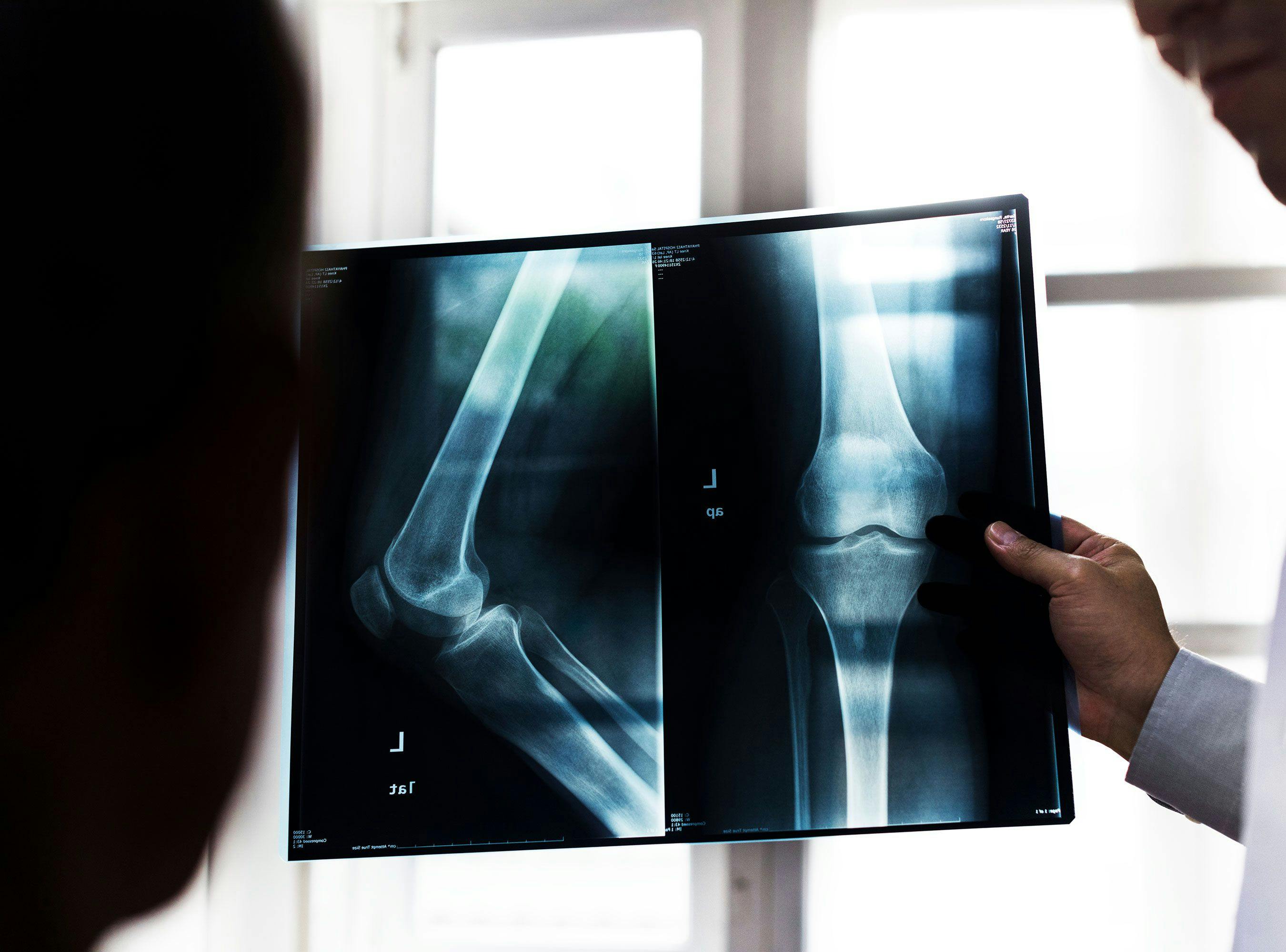 Orthopedic Surgery Expert’s Testimony Challenged as Biased, Unsupported Biomechanical Opinion