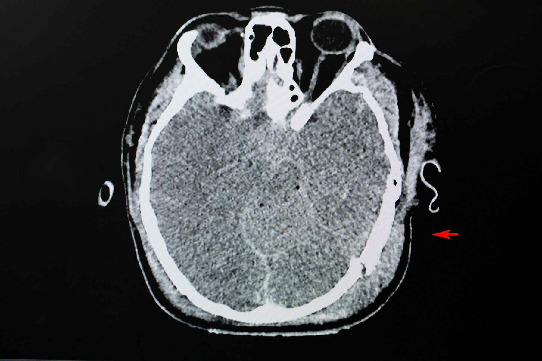 CT scan of skull fracture and cerebral hemorrhage