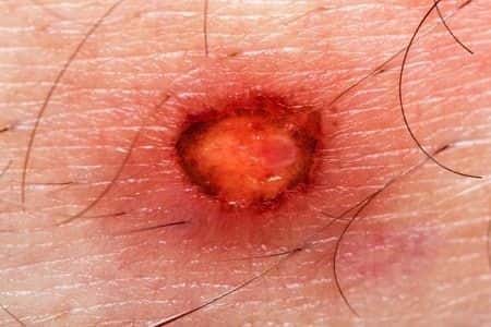 Da Vinci Surgical Device Severely Burns Patient