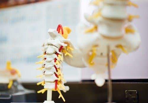 Failure to Treat Cervical Spine AVM Leaves Teen Paralyzed